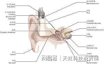 关于人工耳蜗的知识