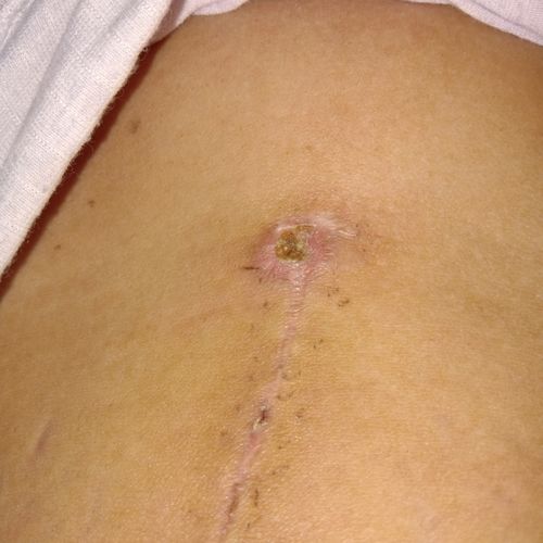 剖腹产竖剖第十八天,刀口下面有个小洞,刚开始一直不愈合,流绿