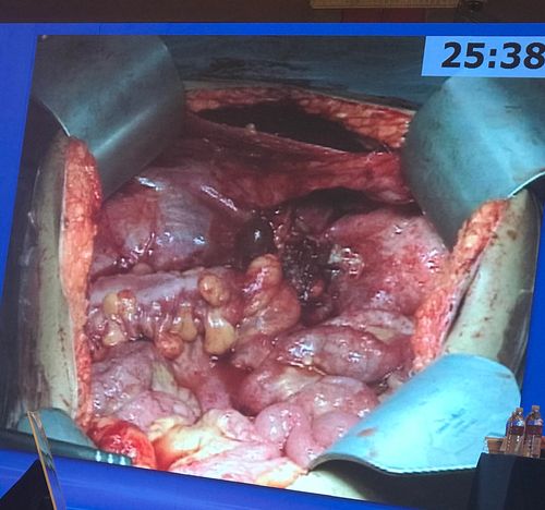 晚期卵巢癌脏层腹膜肿瘤灭术(大量手术图片)