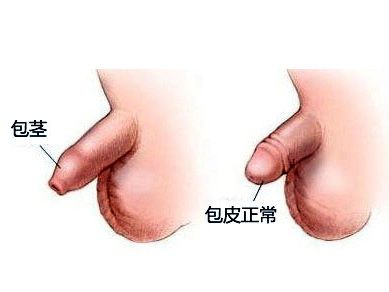养生人群 养生资讯 正文   狭窄环,即产生了嵌顿包茎,多见于儿童好奇