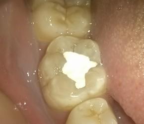 以后还能继续补牙么.牙洞太大了