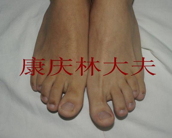 先天性第四跖骨短小症(短趾症)截骨延长的效果-典型病例