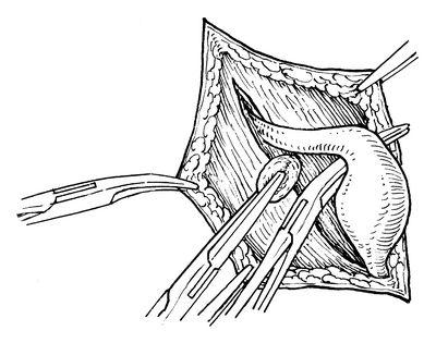 睾丸固定术的图解过程