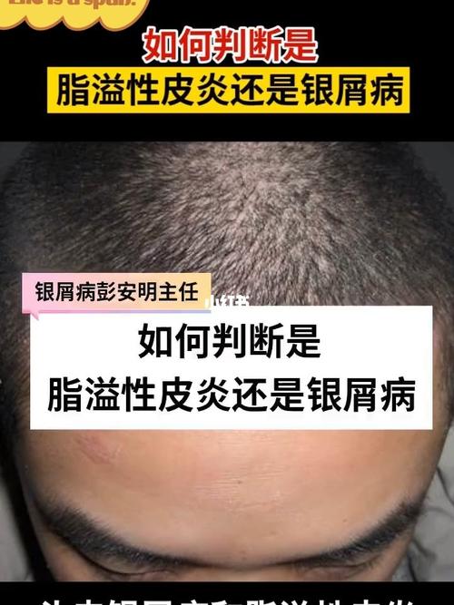 银屑病_脂溢性皮炎_医疗健康_医疗健康其他