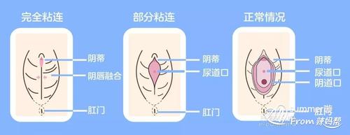 家有女宝宝的看过来 相比男宝宝 女宝宝的生殖器离肛门更近 尿道也更