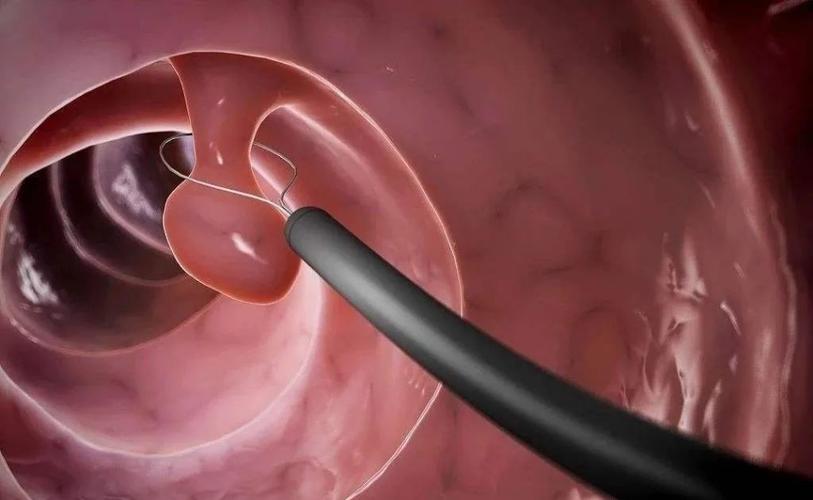 子宫内膜息肉治疗及复发的预防