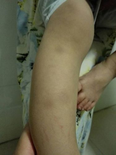了项是腿,家,开,下有小这2两个子单男有斑块出我红血医院验2医消,高的