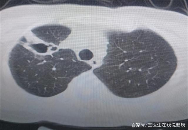 空洞是影像学上可以看到肺部有 空心部位,当肺部病变组织坏死后气体流