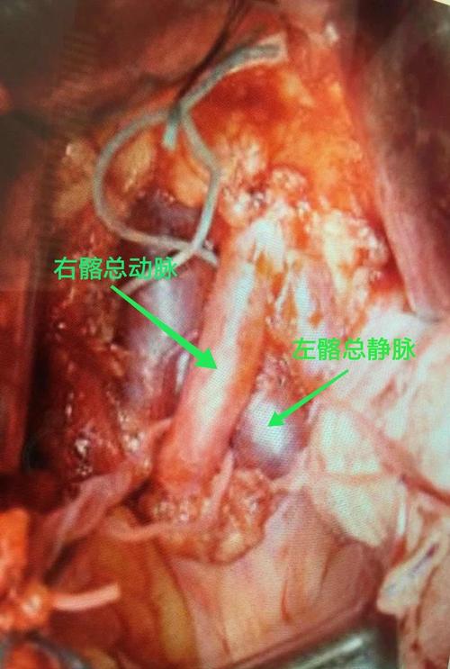 曲沃县人民医院疼痛介入科成功完成一例:髂静脉压迫综合征腔内成形术!