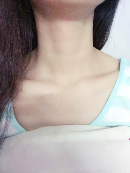 展开全部 锁骨容易发生骨折,儿童多见,骨折时肩关节失去支持,呈下垂