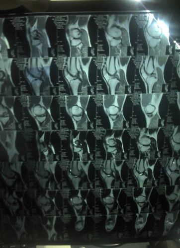 请大家帮我看看膝盖的核磁共振照片吧,万分感谢!