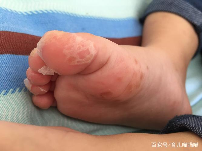 亲身经历,宝宝手足口病初期症状,很可能没被我们重视