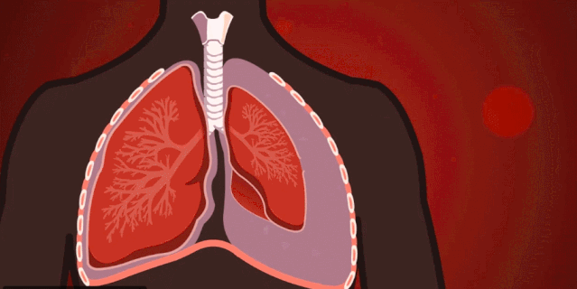 两种,最常见的是继发性肺大疱,多继发于小支气管炎性病变,如哮喘,肺炎