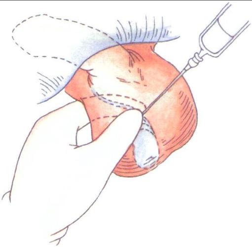 二,绝育术-计划生育手术-医学