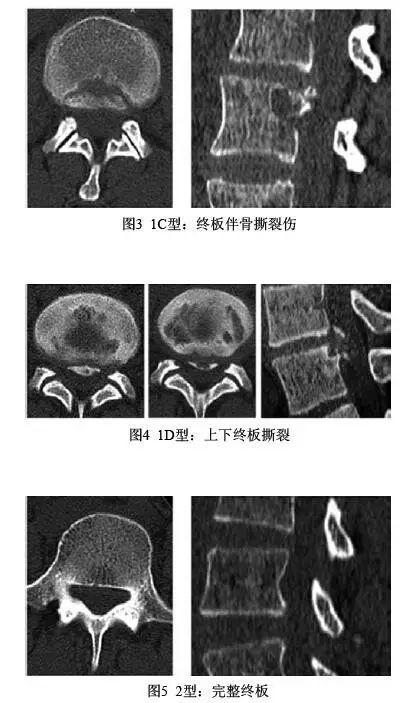 突出的体内证据,终板连接处撕裂比纤维环破裂是椎间盘突出更常见原因