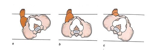 a.骨盆逆时针旋转(向左)  b.正常骨盆位置  c.