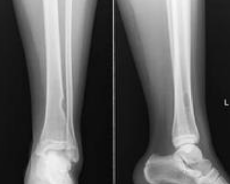 骨癌早期应怎么防治