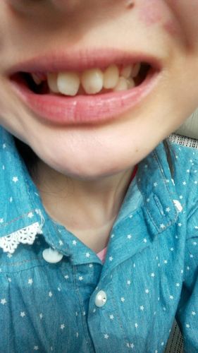 大家好,我今年12岁,门牙俗称为兔牙,暑假想去矫正,门牙中间有条缝