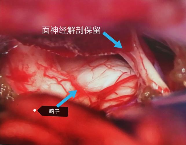 听神经瘤开颅切除术