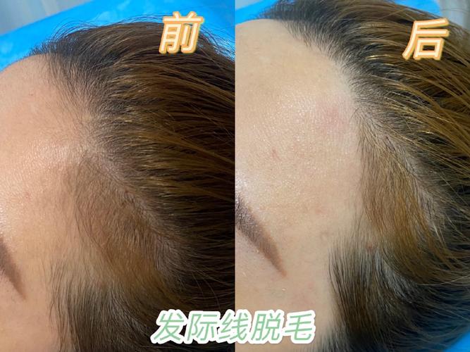 【激光脱毛】脱发际线 一年12次 ,【发际线脱毛】激光脱毛年卡,冰爽