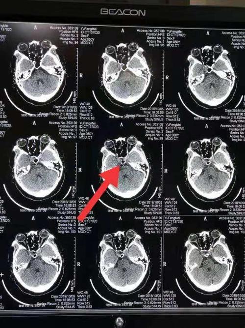 武威市凉州医院神经外科首次在神经内镜下完成武威市第一例经鼻蝶窦