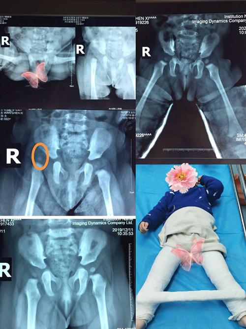 2岁女童,患有"右侧发育性髋关节脱位(ddh)",从1岁多接受系列石膏保守