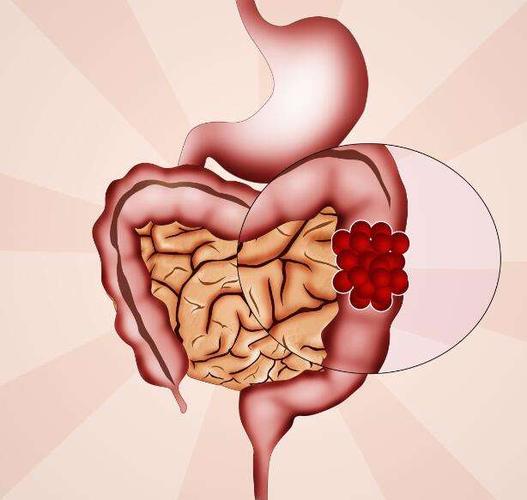 直肠炎出现这个症状后预防直肠炎