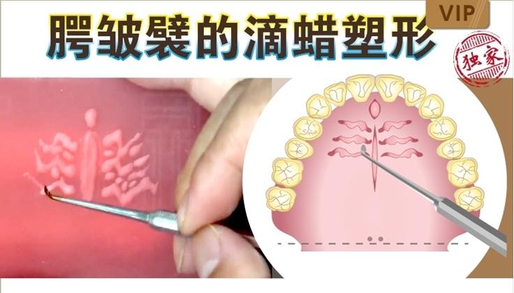 腭皱襞的滴蜡塑形