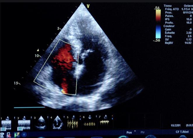 为什么建议用超声心动图检查冠心病超声心动图还可以检查什么
