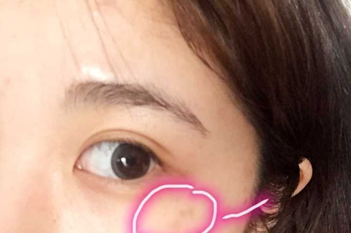 带图 请问眼角这种斑是什么原因造成的?怎么改善?两边