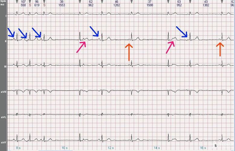 心电图学习20120602(有奖读图第九期)截止到7月1日