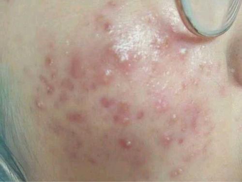 脓包型痘痘:用中药内服外用法治疗效果更佳