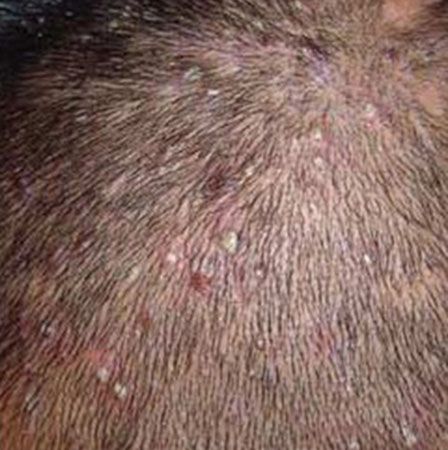 如何治疗和预防儿童毛囊炎