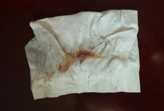 白带带有褐色分泌物 (53)