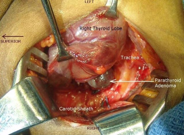 甲状腺手术相关解剖(三)
