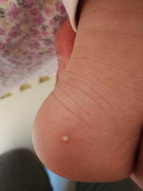 一岁三个月宝宝脚上长了一个小脓包,碰它有点儿疼,是怎么回事?