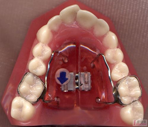 精美矫治器图片