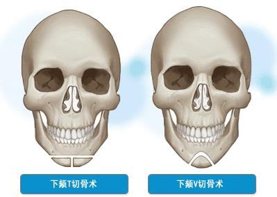 四方脸矫正整形术