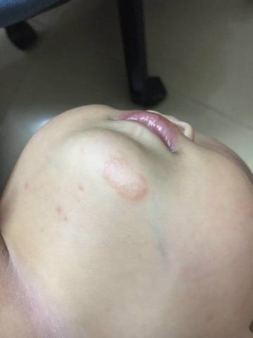 宝宝下巴处有红斑好像是长藓了查仕么药好呢?