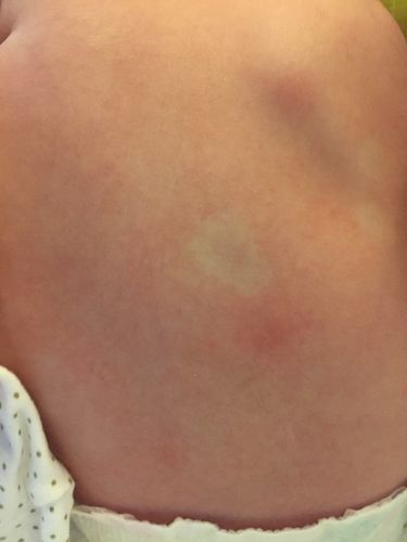 请问三个月宝宝背部有一小块白色的 是什么啊 之前都没有 昨天发现的