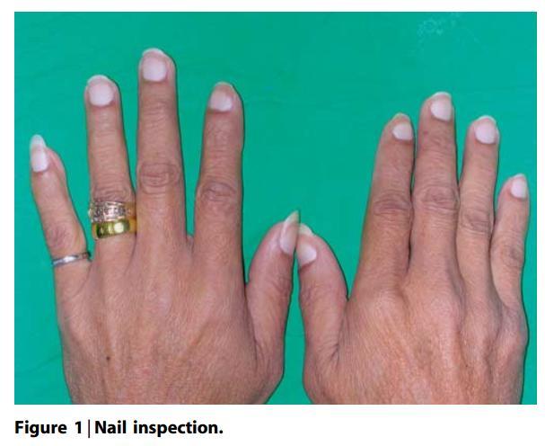 指甲外观有异常,去医院检查,查出血肌酐高,考虑为减肥药导致的尿毒症