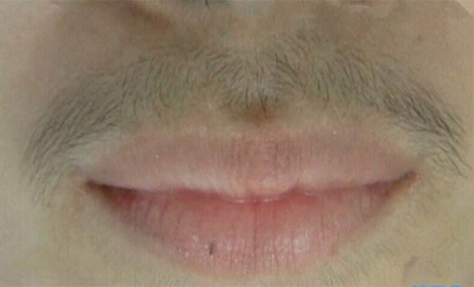 唇毛怎么去除小窍门有哪些