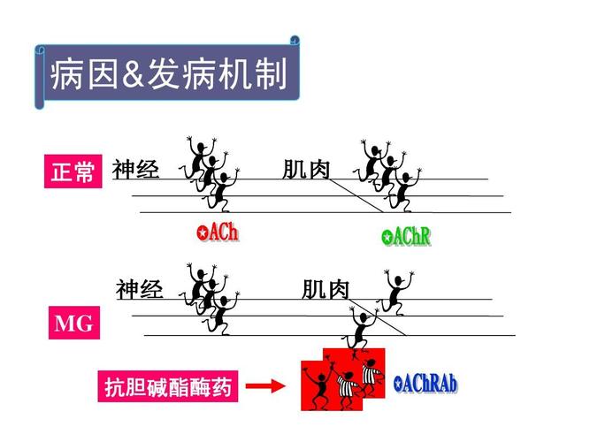 重症肌无力ppt