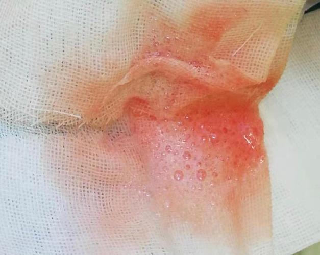 咳出"粉红色泡沫痰"是什么原因?