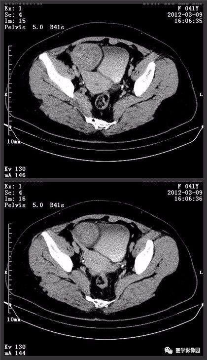 【病例】卵巢颗粒细胞瘤1例ct影像表现