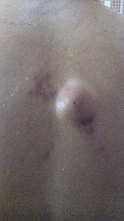 背上长了一个包如图已经有快二十年了不痛不痒有时候大一点有时候瘪一