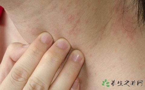 艾滋皮肤初期症状图片 每天没精神是艾滋病