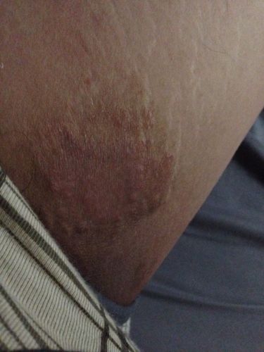 大腿根部两胯长癣,有肉粒的感觉,很痒,越抓越爽,是什么病,该用什