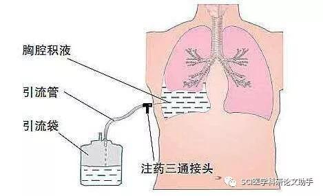 恶性胸腔积液是每天排液更好,还是依据症状排液效果更好?