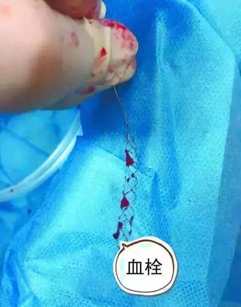 怎样才能"冲"走血栓,远离血栓?